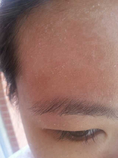 神經性皮炎的治療 (50) 