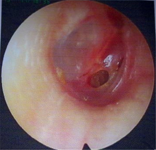 需要修補的鼓膜穿孔