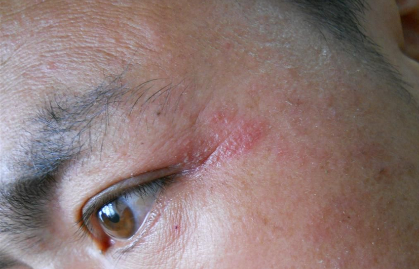 隱翅蟲皮炎眼角