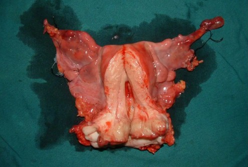 早期外陰癌症狀