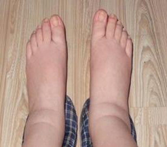 糖尿病腎病腿嚴重變形