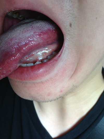 舌癌的初早期症狀