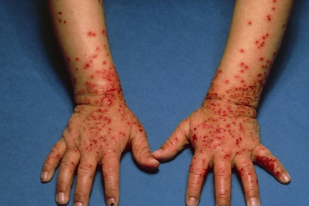 皮膚澱粉樣變 (51) 