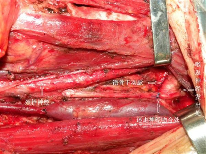 雙側葉甲狀腺癌手術解說