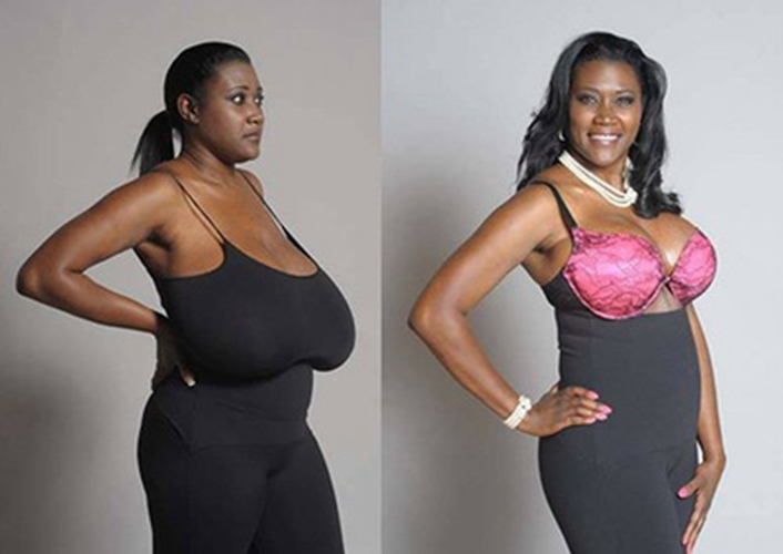 巨乳症治療後對比