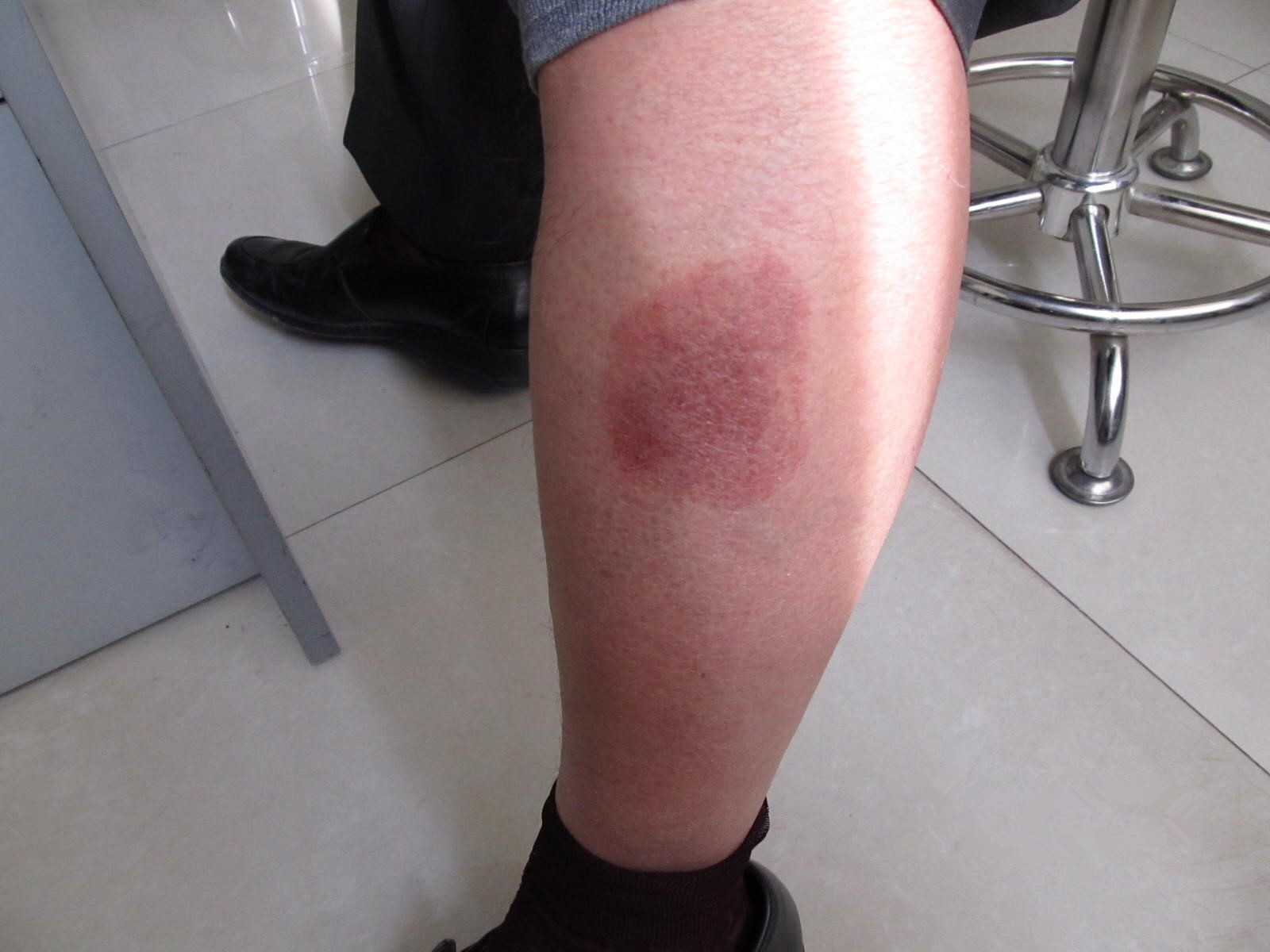 左下肢皮膚結核病