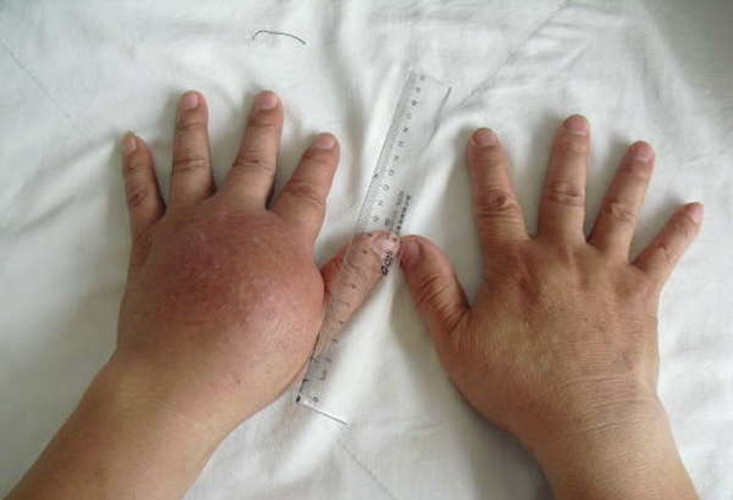 左側手部放射性皮炎