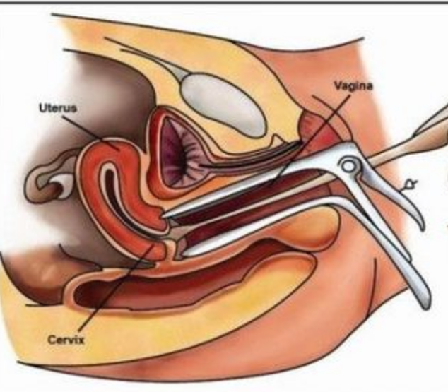 治療中的人工陰道的
