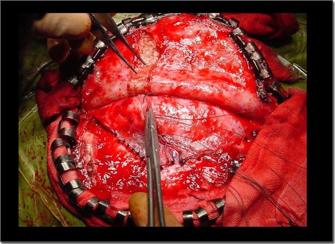 治療腦梗塞手術