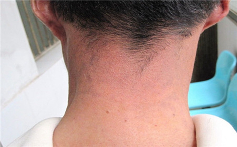 頸部紅斑皮膚黑變病