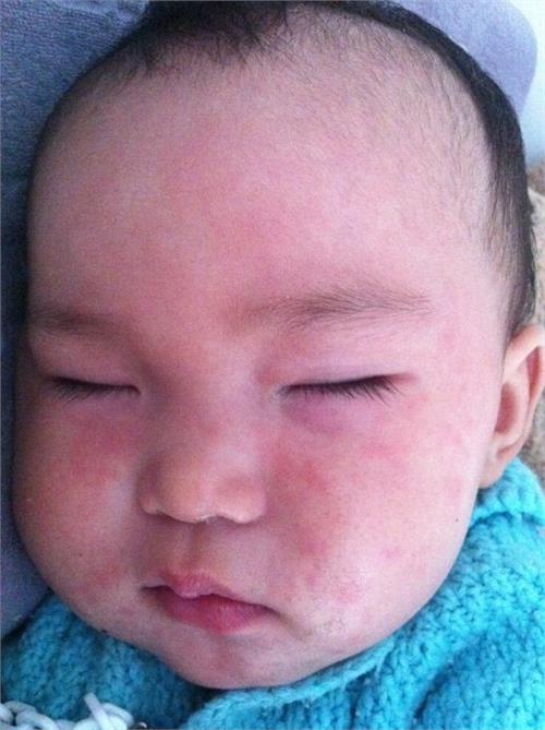 幼兒急疹退燒後又出疹子 