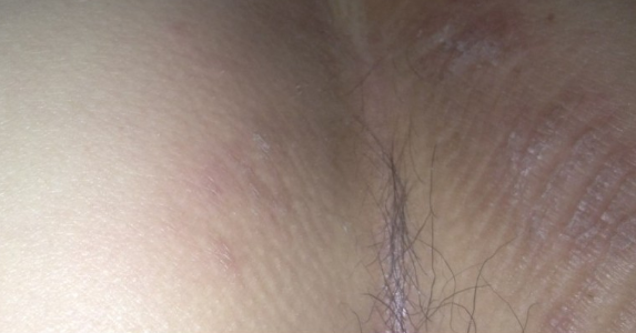 體股癬初期現象