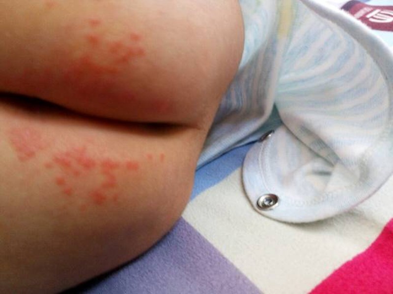 肛周溼疹術後對比