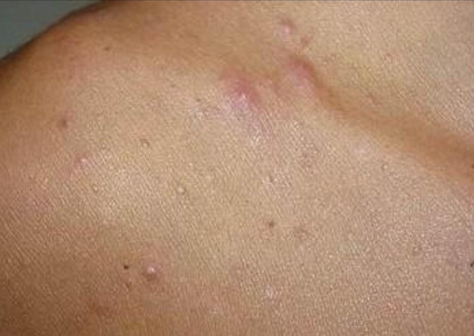 真菌感染是皮囊炎嗎 