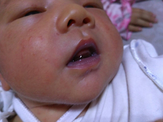 新生兒嘴唇發紫 (47) 