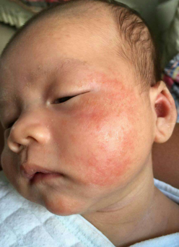 臉上皮膚過敏症狀