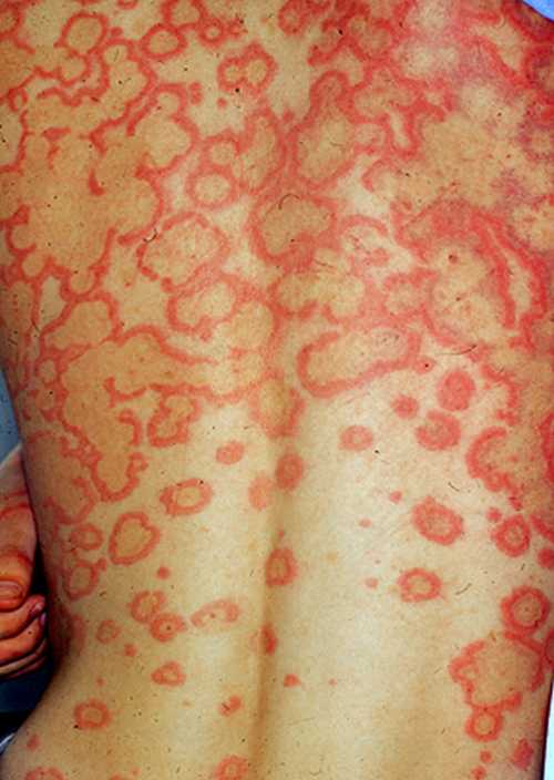 藥物性皮炎症狀