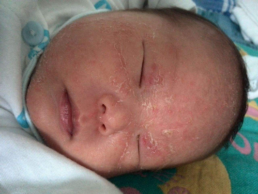 神經性皮炎的治療 (53) 