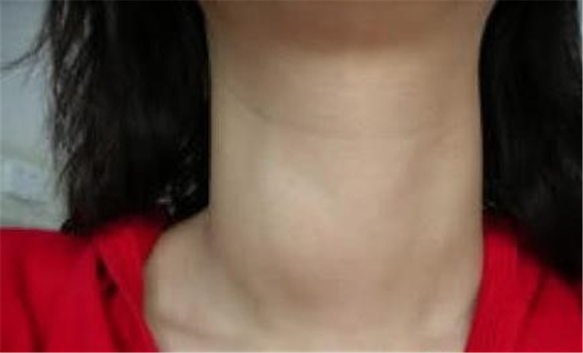 女孩甲狀腺結節