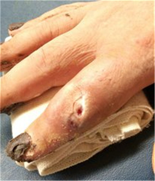 早期骨髓炎治療