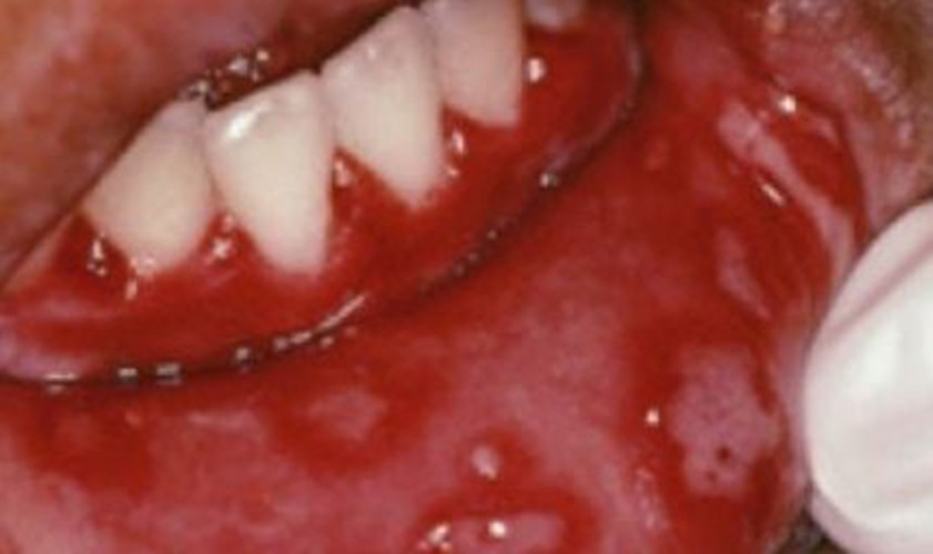 嘴唇白色念珠菌感染 