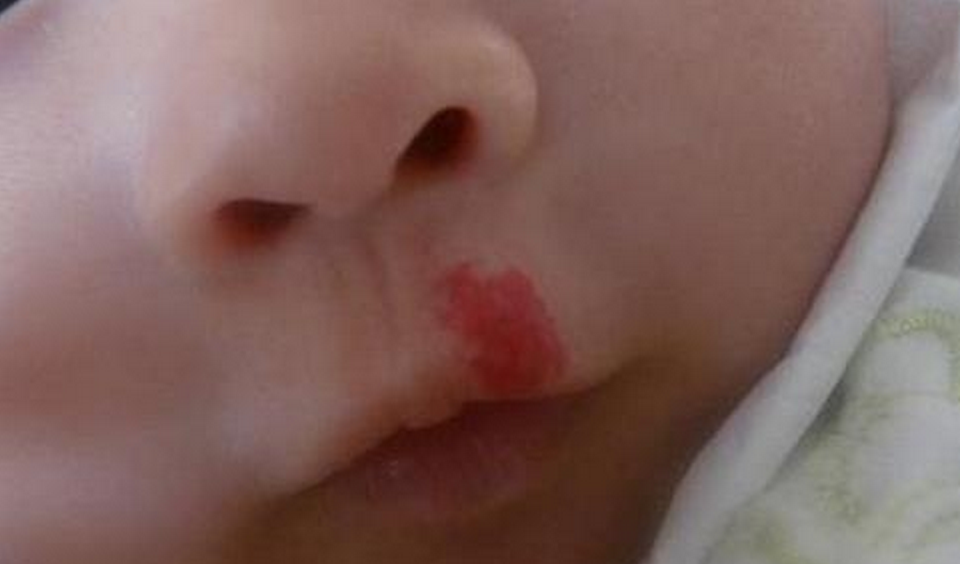 面積不大的鮮紅斑痣