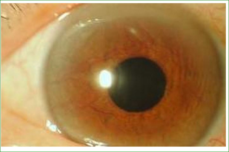 新生血管性青光眼