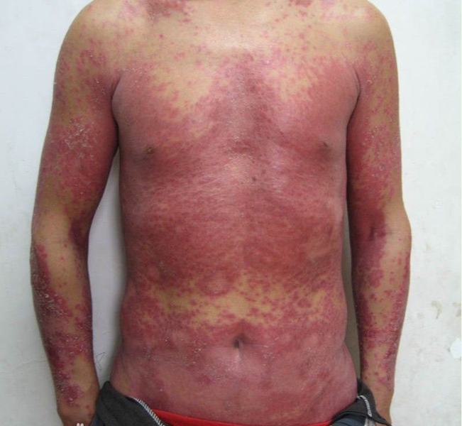 皮膚黃色瘤病全身症狀