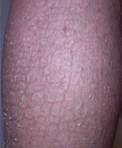 小腿皮膚像魚鱗 (45) 