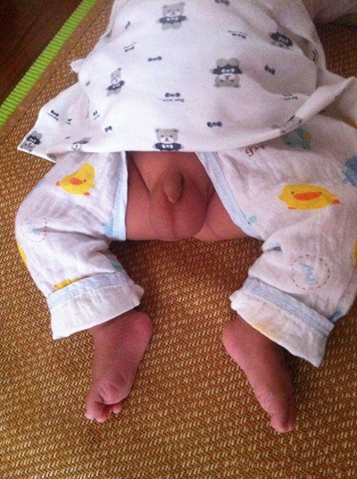 男寶寶疝氣的症狀