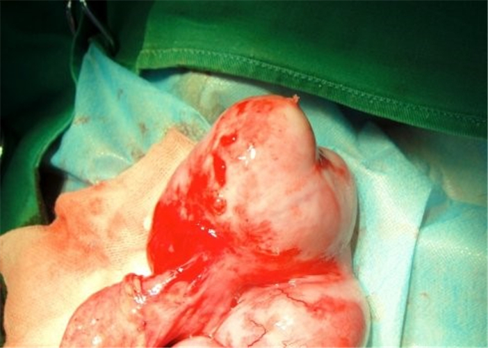 異物引發腸粘連