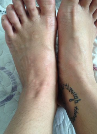 身體蟎蟲過敏症狀