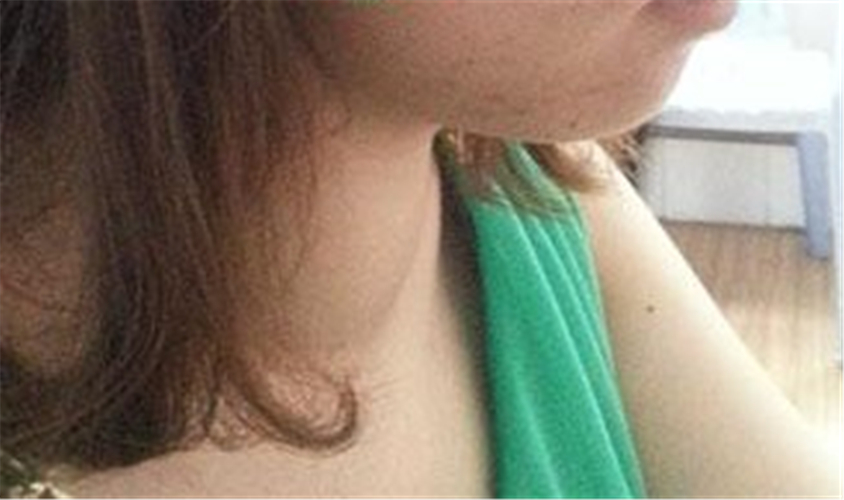 雙側甲狀腺結節