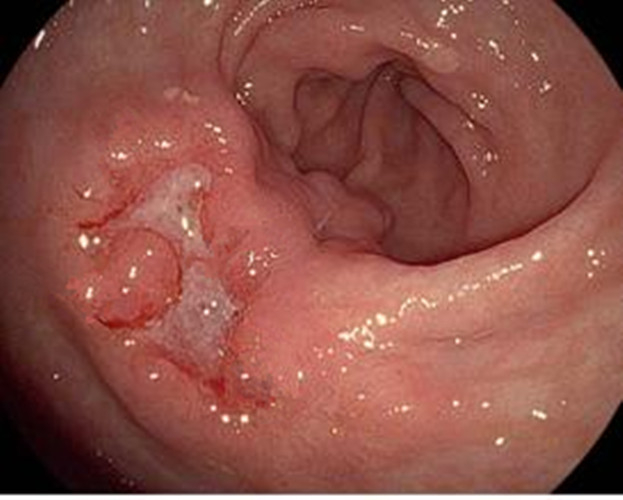 淺表型糜爛慢性胃炎