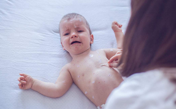 長水痘的症狀 (52) 