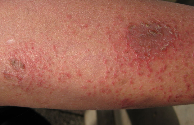 皮膚澱粉樣變 (55) 