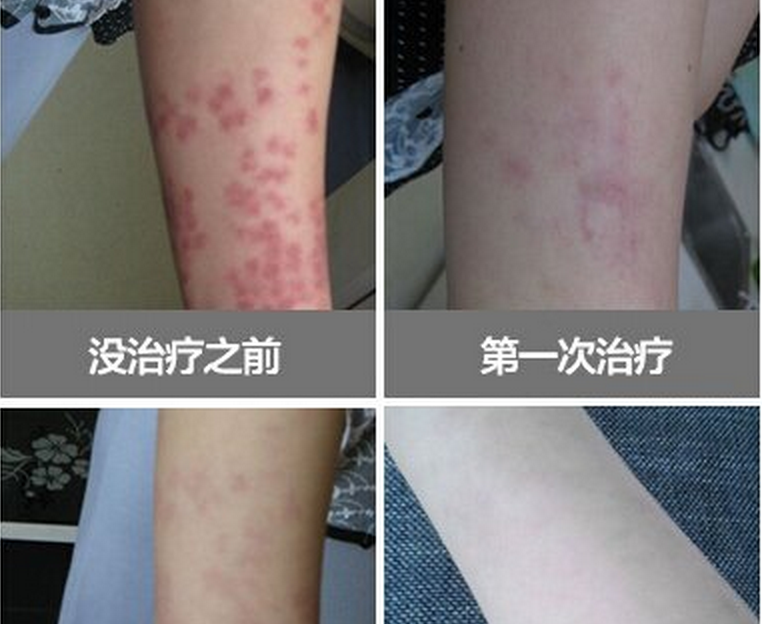 鮮紅斑痣手臂治療效果