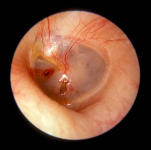 外傷使鼓膜穿孔