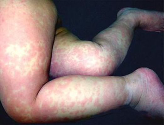 小兒猩紅熱症狀