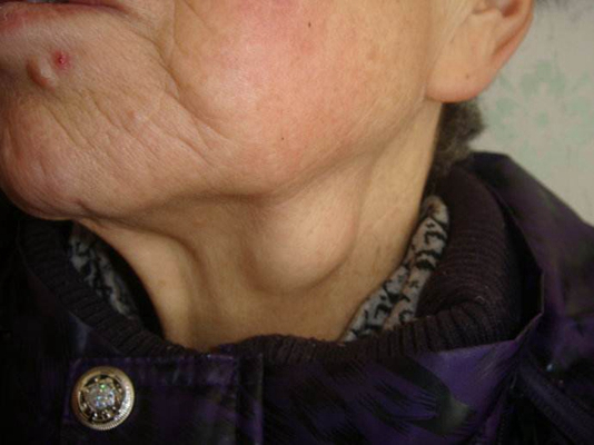 頜下淋巴結腫大