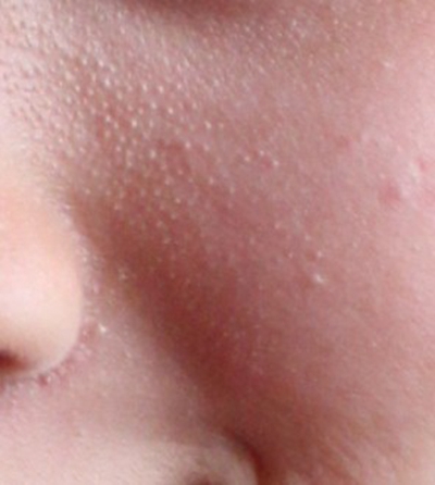 粟丘疹 (45) 