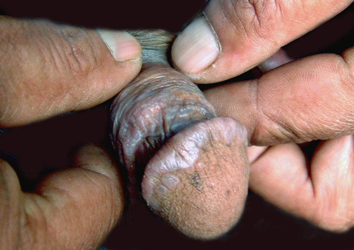 陰莖部扁平大皰性皮膚病