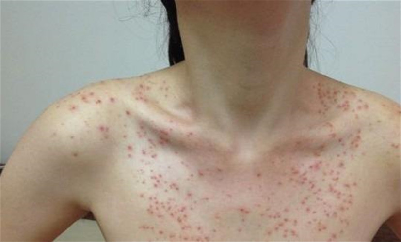 傳染性軟疣治療方法 