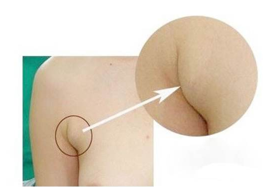 慢性淋巴結炎 (7) 