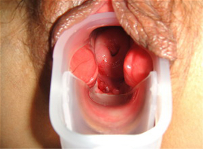 外陰癌早期分泌物