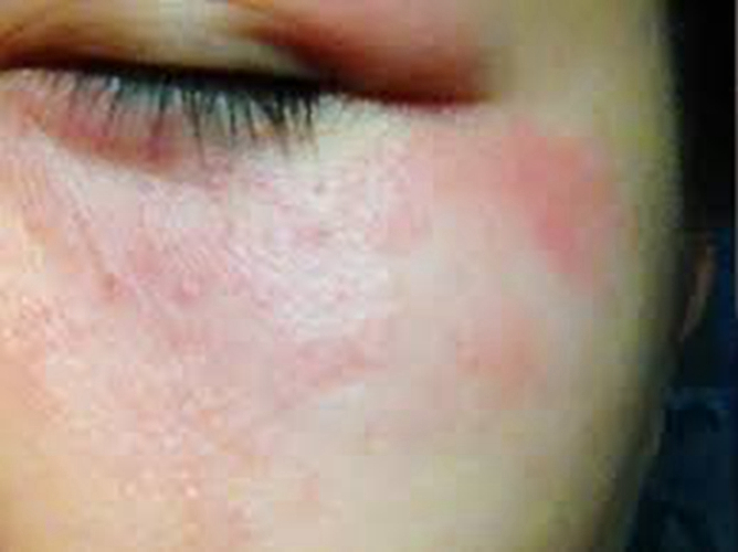 眼部紅疙瘩異位性皮炎