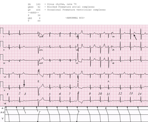 頻發房性早搏 (28) 