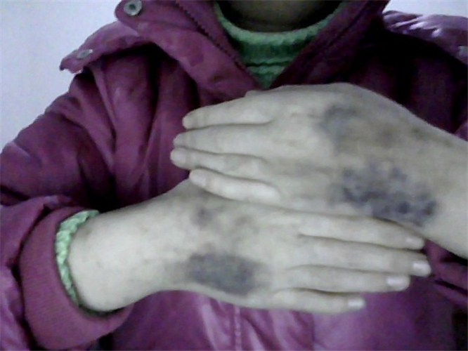 再生障礙性貧血手部