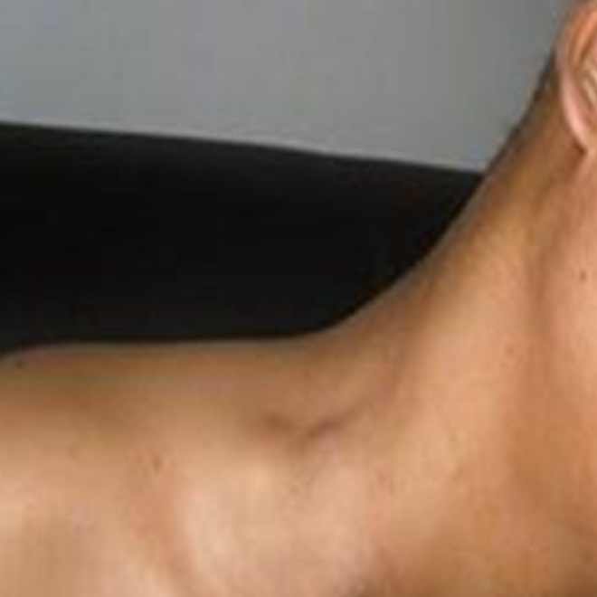 腋下淋巴癌早期症狀