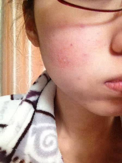 神經性皮炎的治療 (51) 